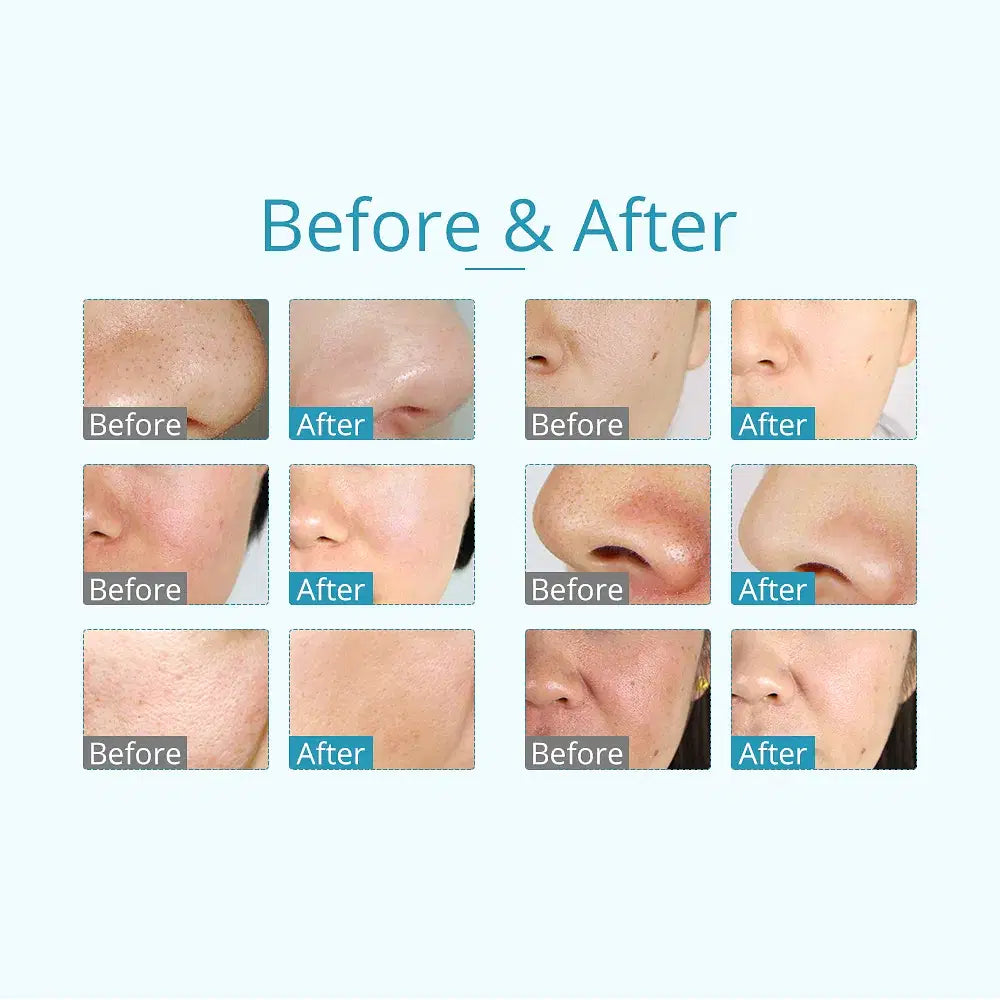 Color: White, Ships From: United States - 3 In 1 Vacuum Diamond Tip Microdermabrasion Machine Acne Blackhead Removal Skin Rejuvenation Water Spray Facial Beauty Machine